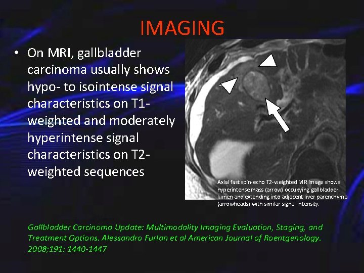 IMAGING • On MRI, gallbladder carcinoma usually shows hypo- to isointense signal characteristics on