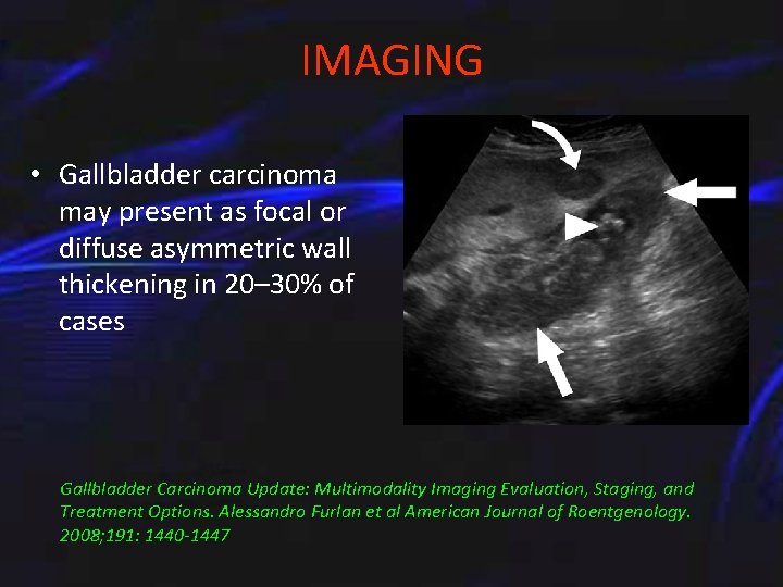 IMAGING • Gallbladder carcinoma may present as focal or diffuse asymmetric wall thickening in
