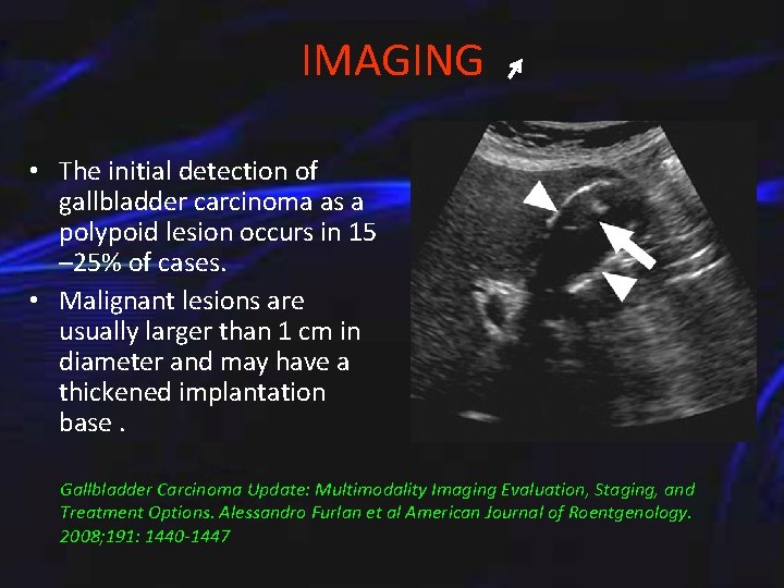 IMAGING • The initial detection of gallbladder carcinoma as a polypoid lesion occurs in