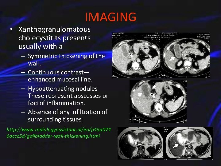 IMAGING • Xanthogranulomatous cholecystitits presents usually with a – Symmetric thickening of the wall,