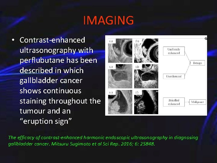 IMAGING • Contrast-enhanced ultrasonography with perflubutane has been described in which gallbladder cancer shows