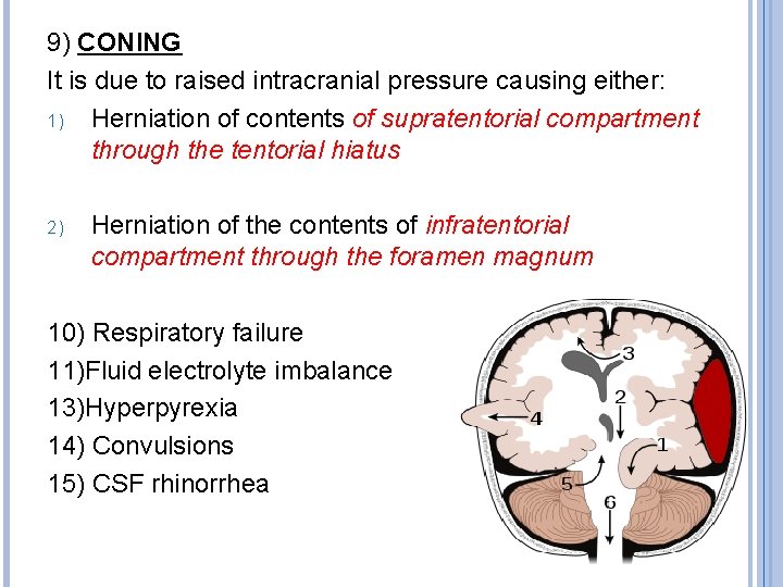 9) CONING It is due to raised intracranial pressure causing either: 1) Herniation of