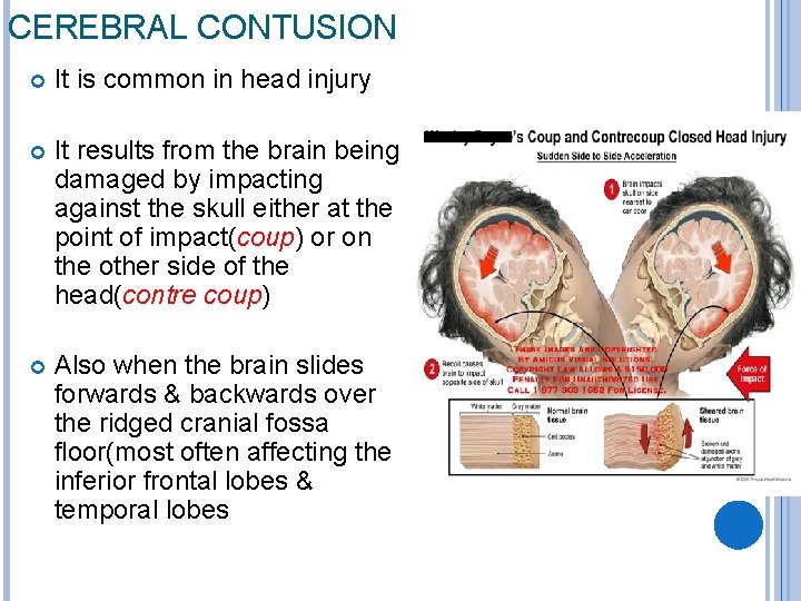 CEREBRAL CONTUSION It is common in head injury It results from the brain being