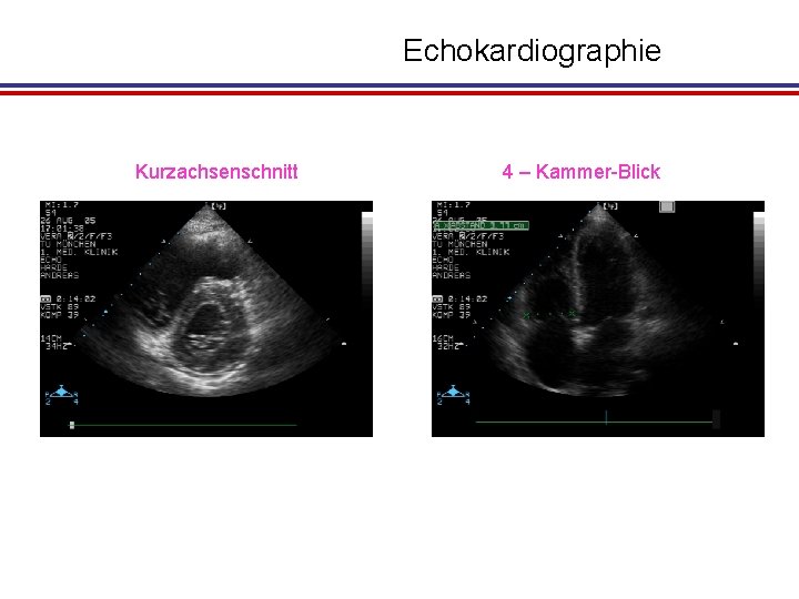 Echokardiographie Kurzachsenschnitt 4 – Kammer-Blick 