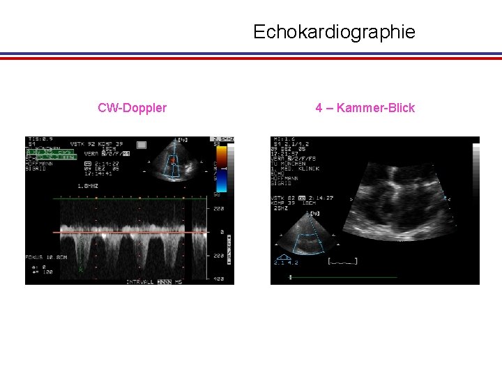 Echokardiographie CW-Doppler 4 – Kammer-Blick 