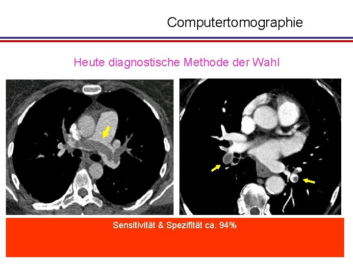 Computertomographie Heute diagnostische Methode der Wahl Sensitivität & Spezifität ca. 94% Diagnostik zentraler Lungenembolien