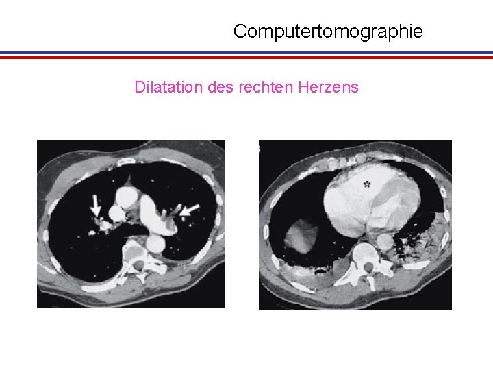 Computertomographie Dilatation des rechten Herzens 