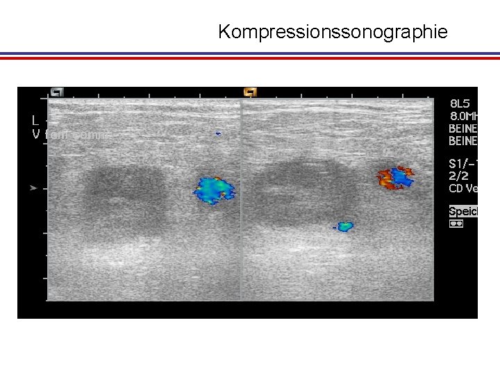 Kompressionssonographie 