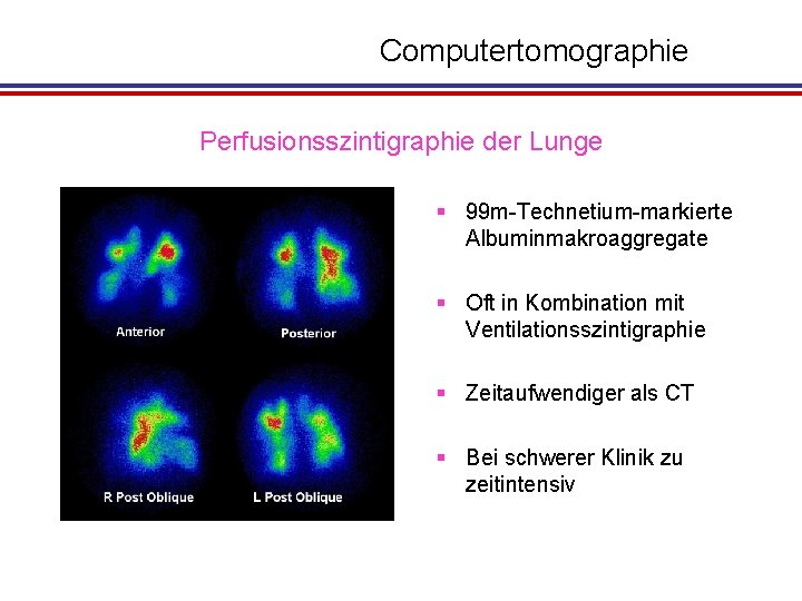 Computertomographie Perfusionsszintigraphie der Lunge § 99 m-Technetium-markierte Albuminmakroaggregate § Oft in Kombination mit Ventilationsszintigraphie