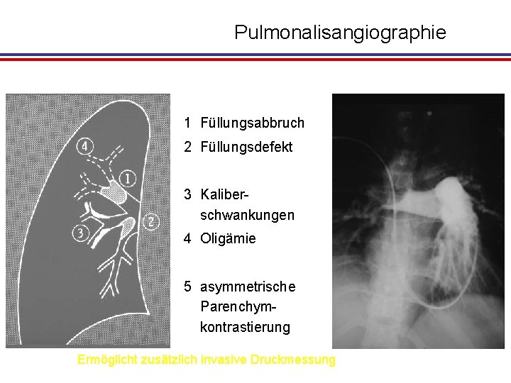 Pulmonalisangiographie 1 Füllungsabbruch 2 Füllungsdefekt 3 Kaliberschwankungen 4 Oligämie 5 asymmetrische Parenchymkontrastierung Ermöglicht zusätzlich