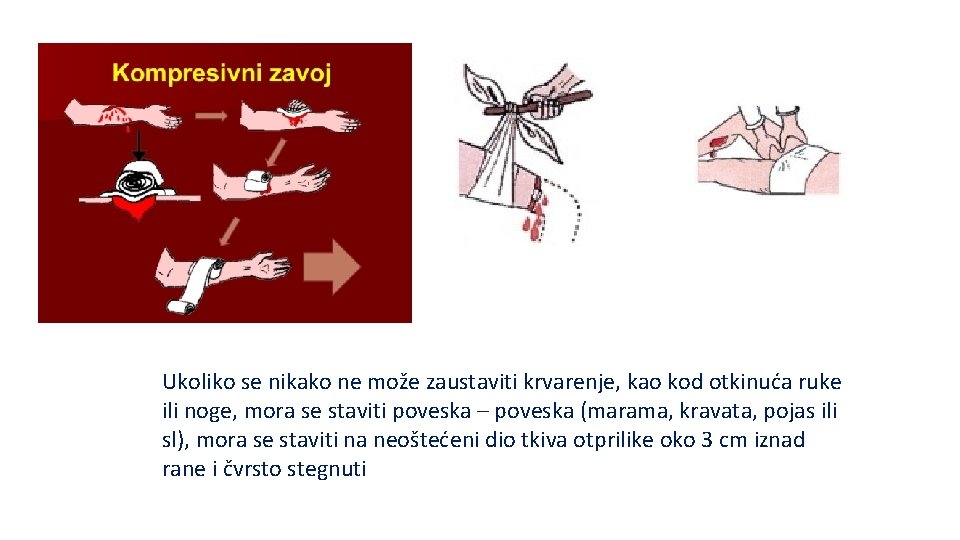 Ukoliko se nikako ne može zaustaviti krvarenje, kao kod otkinuća ruke ili noge, mora