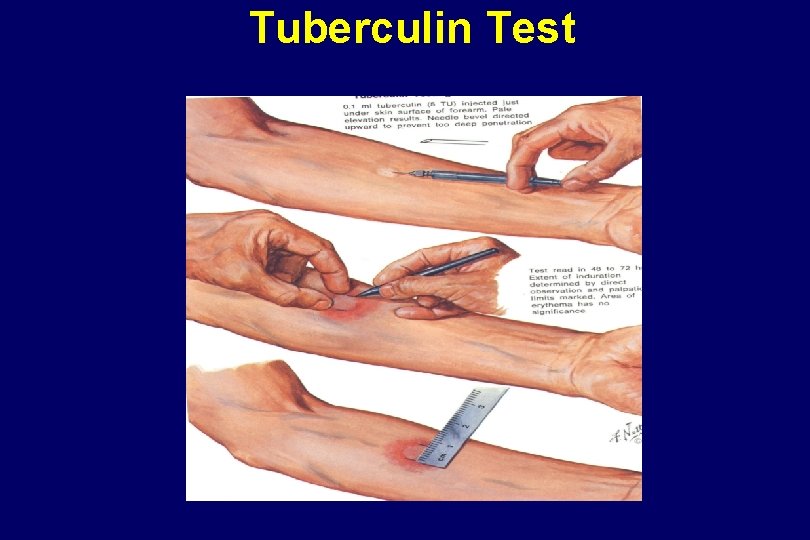 Tuberculin Test 