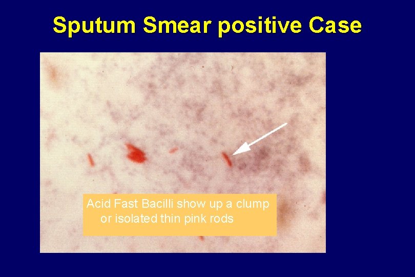 Sputum Smear positive Case Acid Fast Bacilli show up a clump or isolated thin