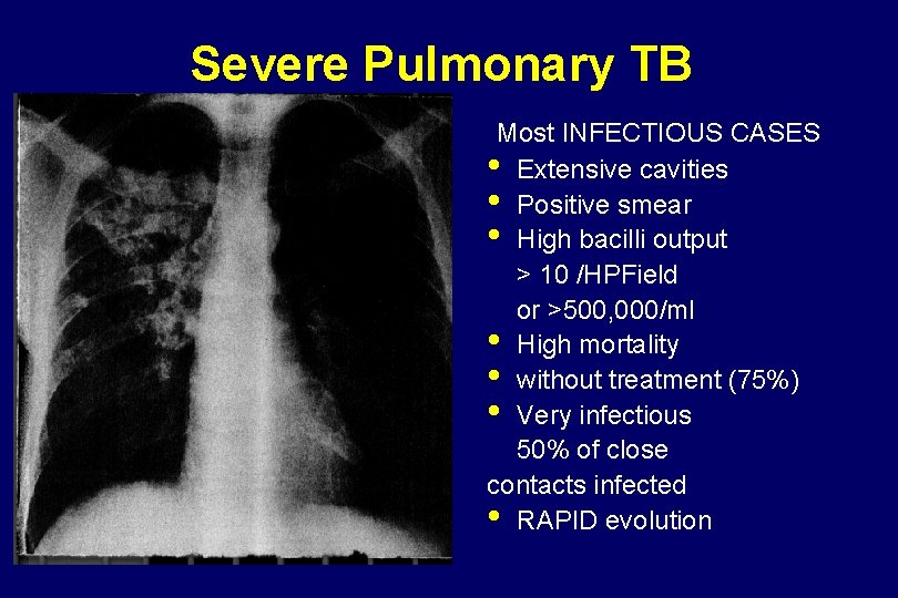 Severe Pulmonary TB Most INFECTIOUS CASES • Extensive cavities • Positive smear • High