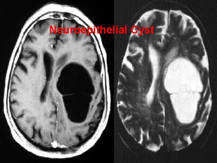 Neuroepithelial Cyst 