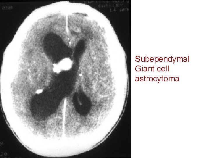 Subependymal Giant cell astrocytoma 