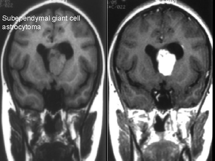 Subependymal giant cell astrocytoma 