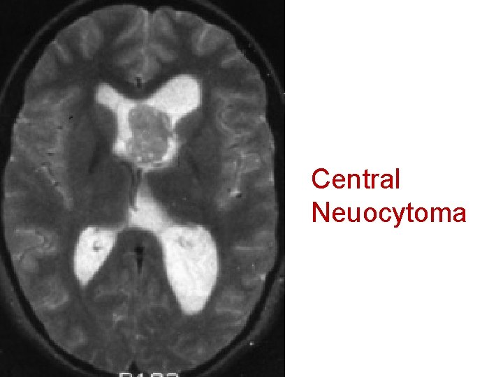 Central Neuocytoma 