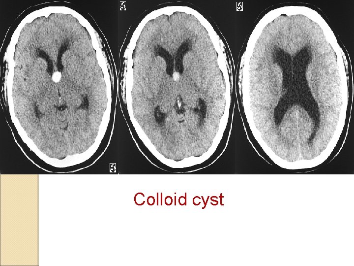 Colloid cyst 