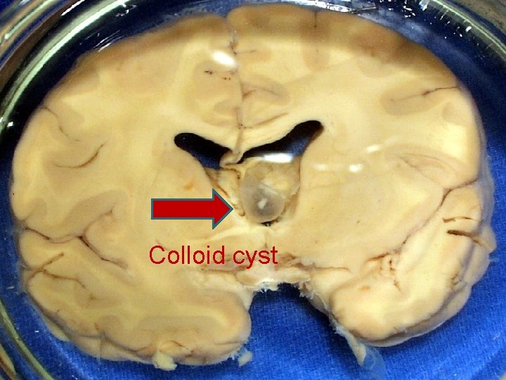 Colloid cyst 