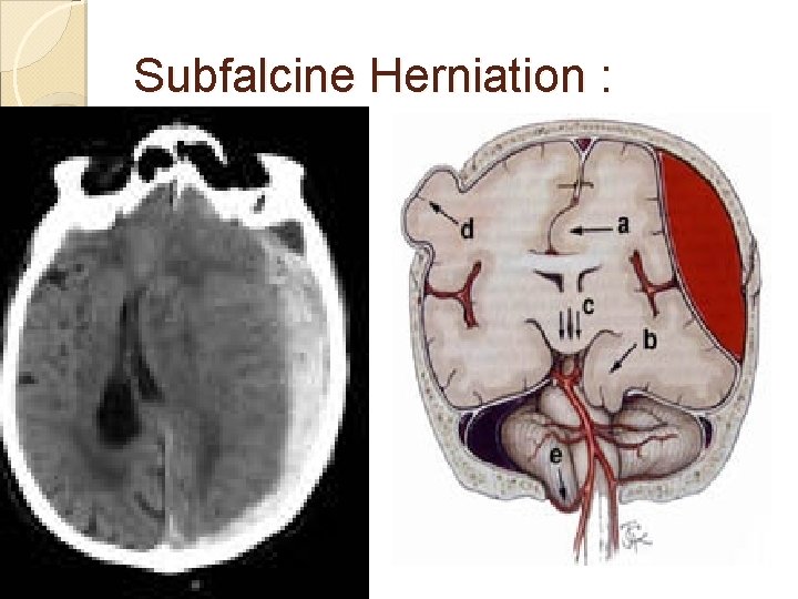 Subfalcine Herniation : 