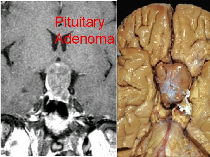 Pituitary Adenoma 