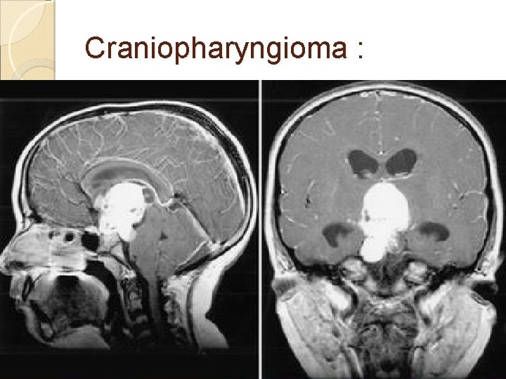 Craniopharyngioma : 