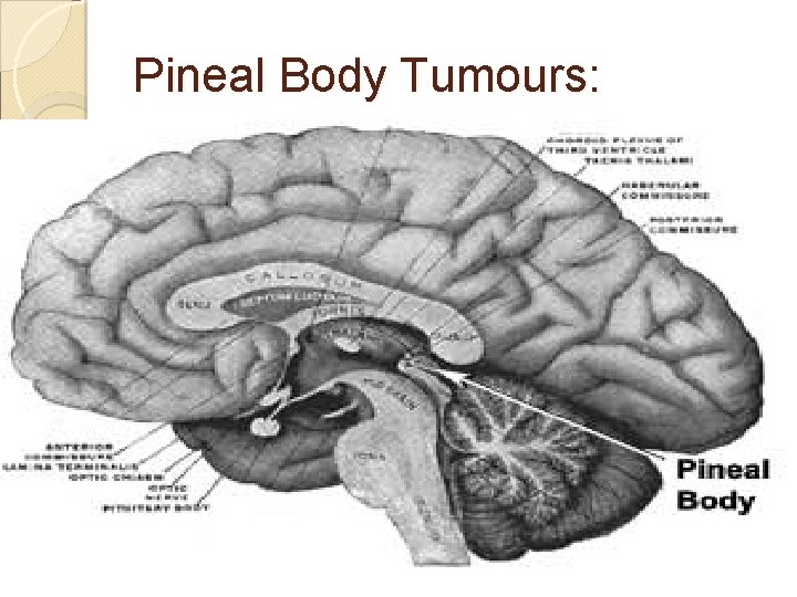 Pineal Body Tumours: 