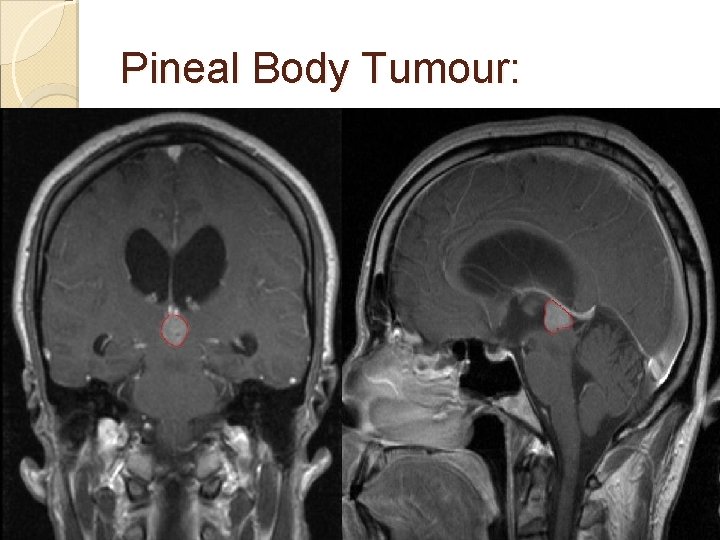Pineal Body Tumour: 
