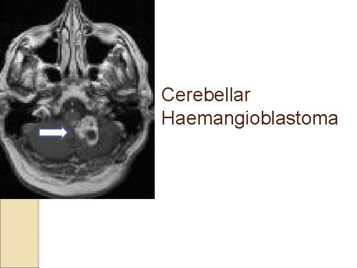Cerebellar Haemangioblastoma 