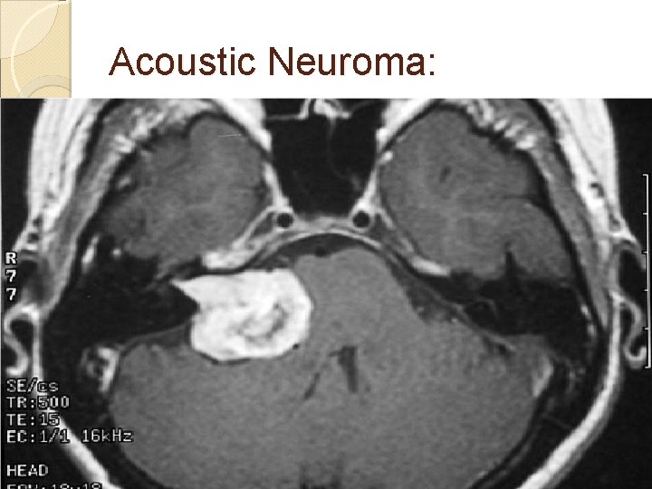 Acoustic Neuroma: 