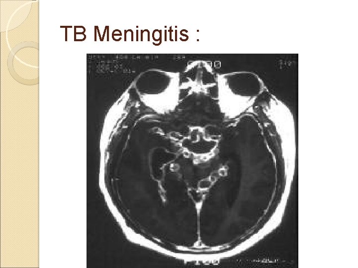 TB Meningitis : 