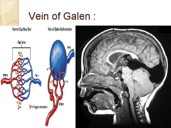 Vein of Galen : 
