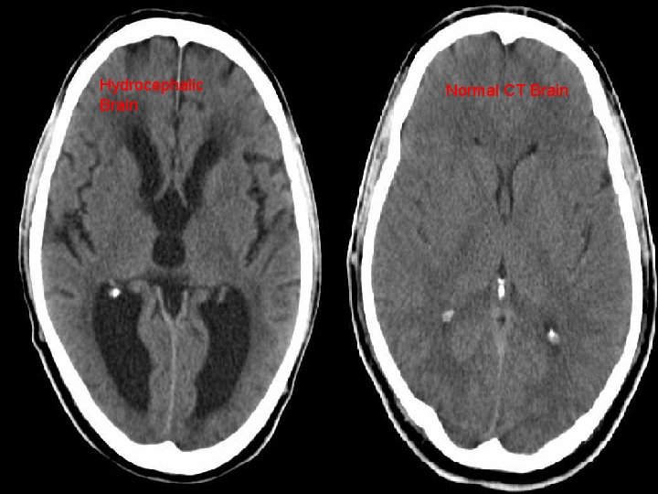 Hydrocephalic Brain Normal CT Brain 