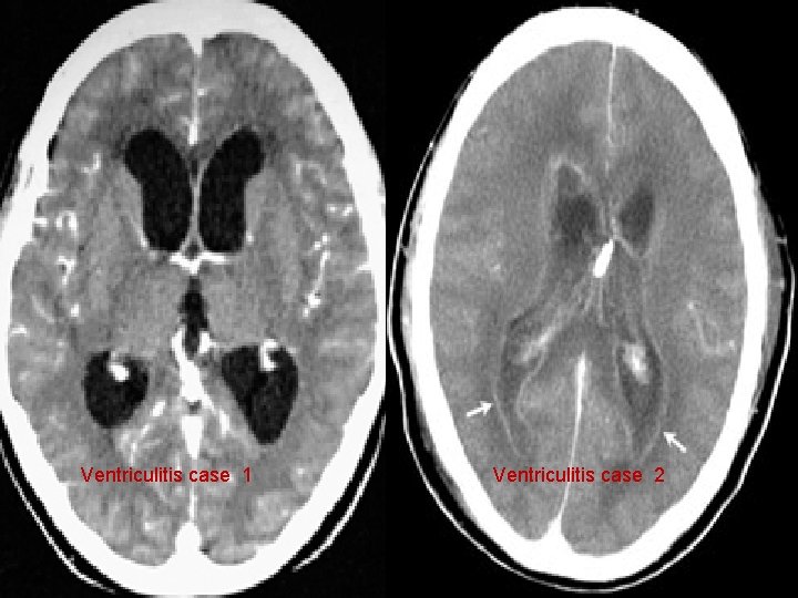 Ventriculitis case 1 Ventriculitis case 2 