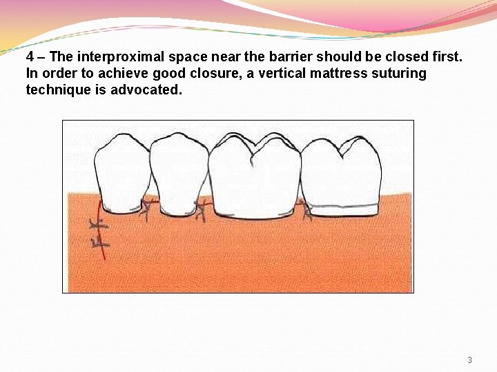 4 – The interproximal space near the barrier should be closed first. In order