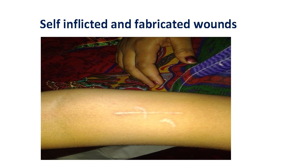 Self inflicted and fabricated wounds Self inflicted and fabricated wounds