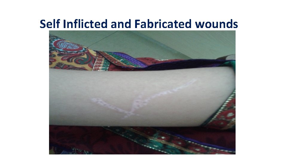 Self Inflicted and Fabricated wounds Self Inflicted and Fabricated wounds