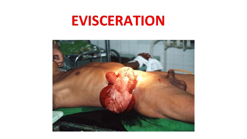 EVISCERATION EVISCERATION