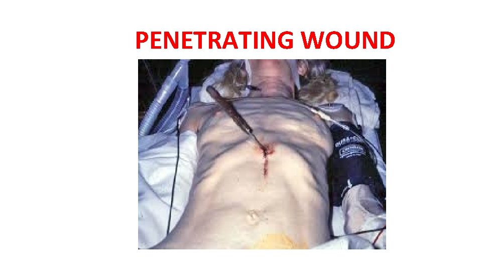 PENETRATING WOUND PENETRATING WOUND