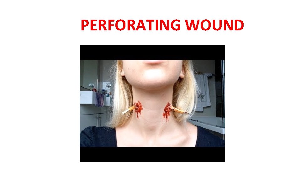 PERFORATING WOUND PERFORATING WOUND