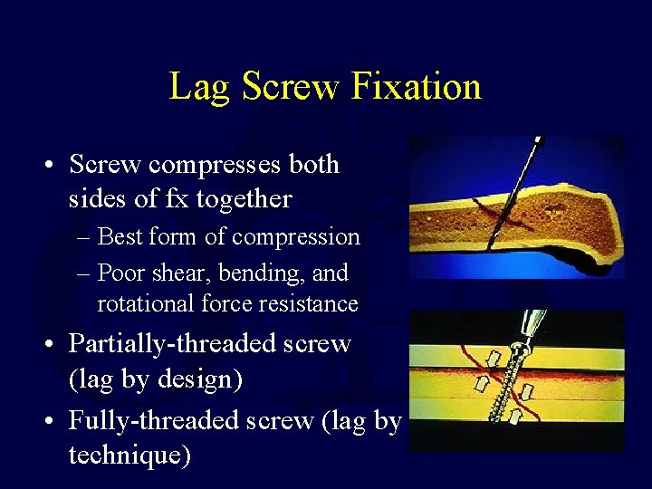 Lag Screw Fixation • Screw compresses both sides of fx together – Best form