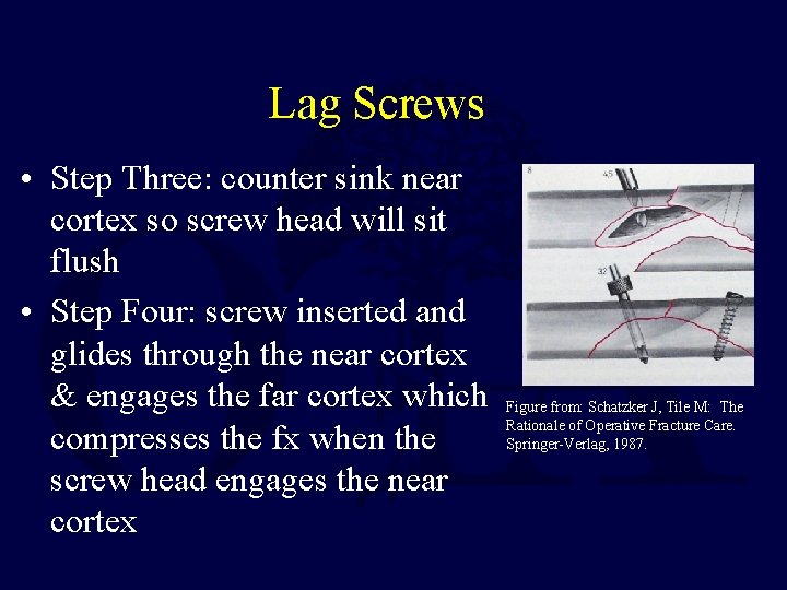 Lag Screws • Step Three: counter sink near cortex so screw head will sit