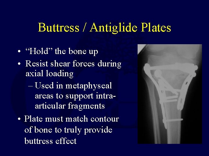 Buttress / Antiglide Plates • “Hold” the bone up • Resist shear forces during