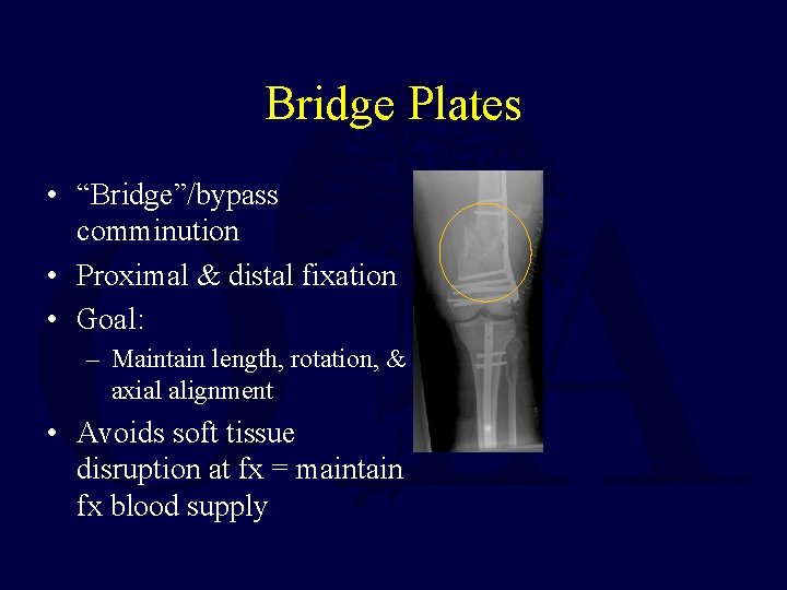 Bridge Plates • “Bridge”/bypass comminution • Proximal & distal fixation • Goal: – Maintain