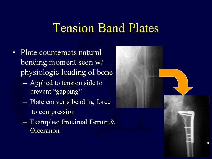 Tension Band Plates • Plate counteracts natural bending moment seen w/ physiologic loading of
