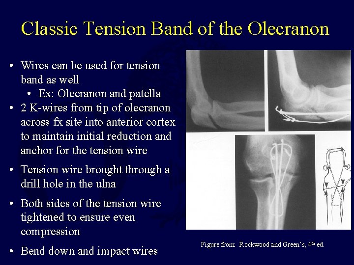 Classic Tension Band of the Olecranon • Wires can be used for tension band