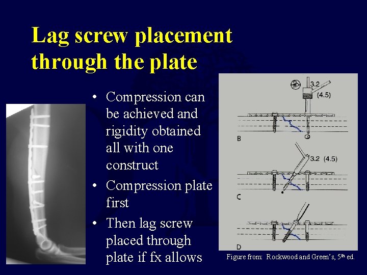 Lag screw placement through the plate • Compression can be achieved and rigidity obtained