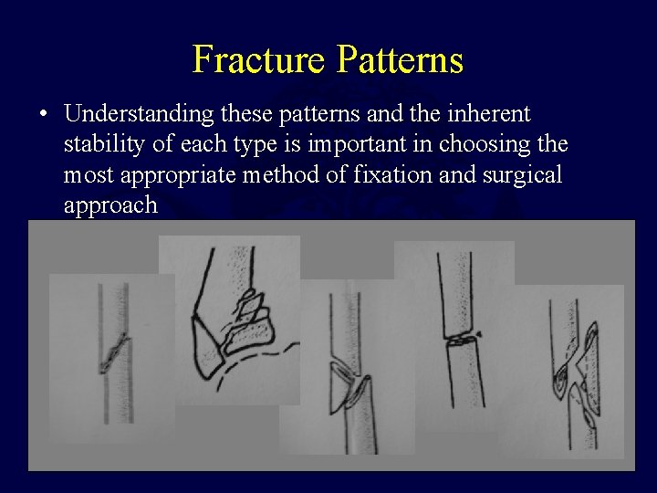 Fracture Patterns • Understanding these patterns and the inherent stability of each type is