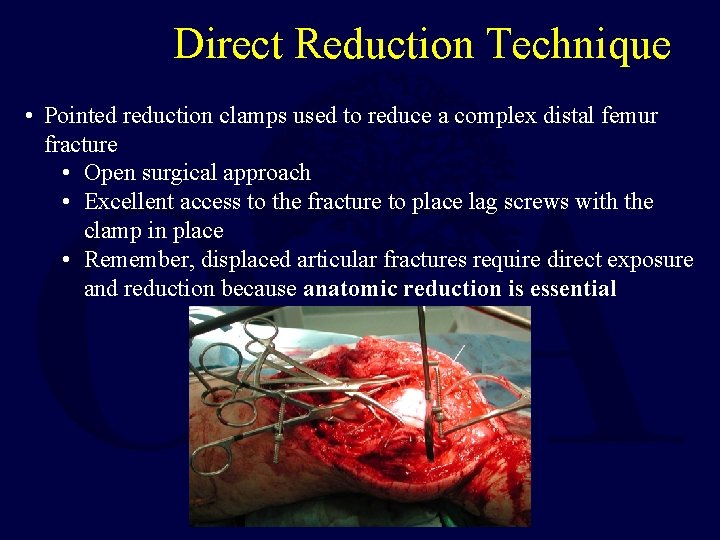 Direct Reduction Technique • Pointed reduction clamps used to reduce a complex distal femur